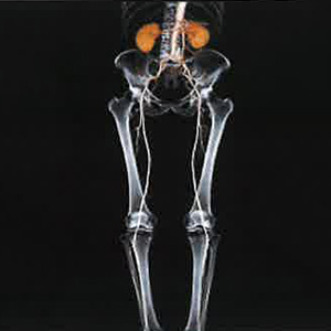 CT 3D画像